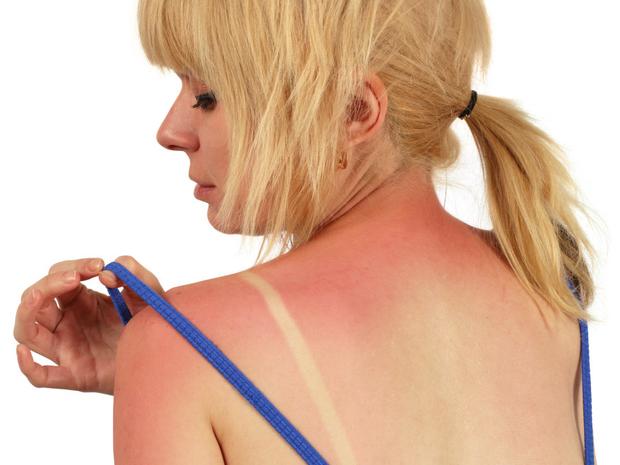 Что нельзя делать при солнечном ожоге. Смотреть фото Что нельзя делать при солнечном ожоге. Смотреть картинку Что нельзя делать при солнечном ожоге. Картинка про Что нельзя делать при солнечном ожоге. Фото Что нельзя делать при солнечном ожоге Что нельзя делать при солнечном ожоге. Смотреть фото Что нельзя делать при солнечном ожоге. Смотреть картинку Что нельзя делать при солнечном ожоге. Картинка про Что нельзя делать при солнечном ожоге. Фото Что нельзя делать при солнечном ожоге